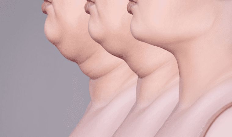 آب کردن غبغب