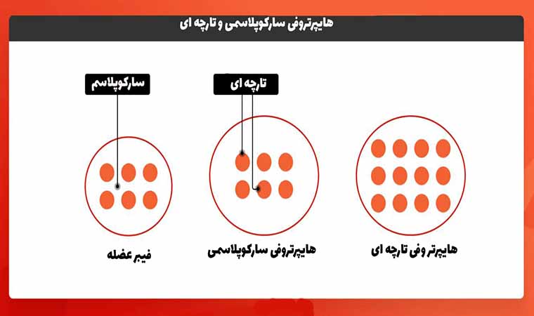 هایپرتروفی سارکوپلاسمی و تارچه ای