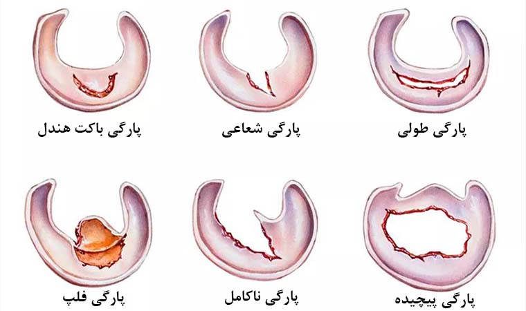 پارگی مینیسک زانو