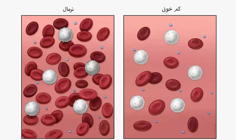 کم خونی و فقر آهن