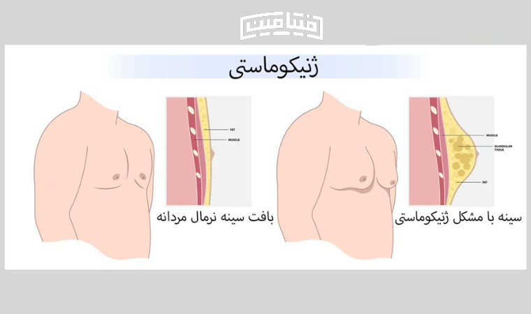 چربی سینه مردان - ژنیکوماستی چیست