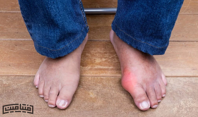 بیماری نقرس