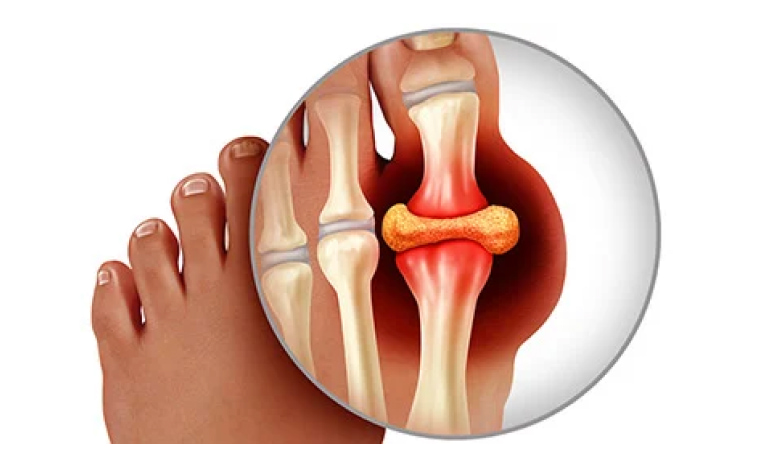 بیماری نقرس